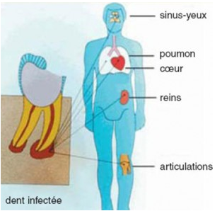 Dent infectée et les répercussion